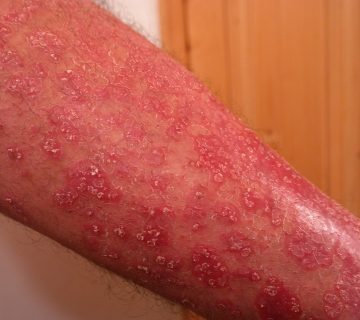 Last van heftige psoriasis Bezoek de Dode Zee het liefst nog vandaag